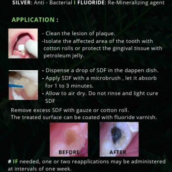 Dengen Caries Arrest Silver Diamine Fluoride 38% - Image 4