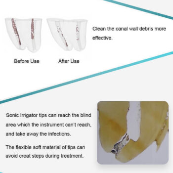 GLIN Sonic Endo Irrigator (30 Tips Free) dental Ultrasonic Endo activator kit - Image 4