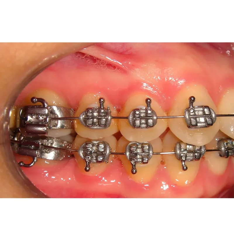 D-Tech Iridium Master (MBT Prescription Mini Brackets) | Dental Product at Lowest Price