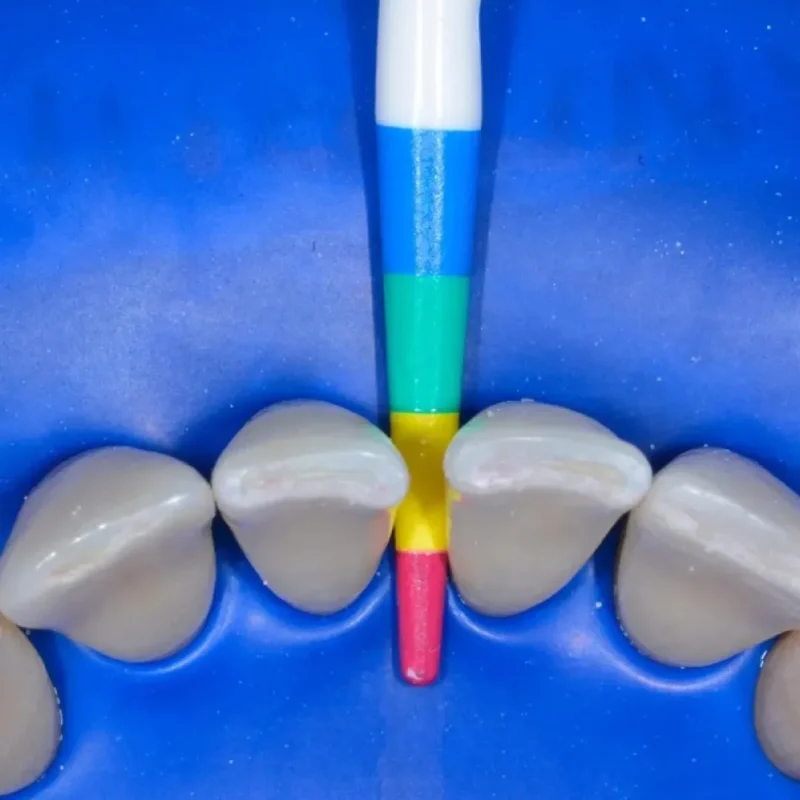 Bioclear Black Triangle Procedure Matrix System Kit | Dental Product at Lowest Price