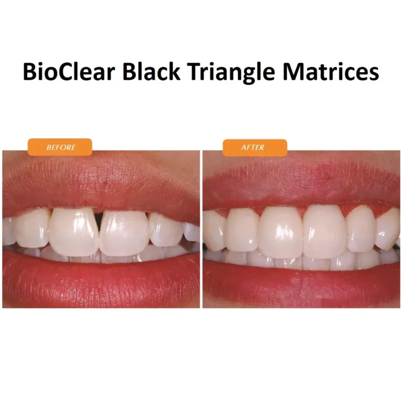 Bioclear Black Triangle Anterior Matrices - Refills Pack of 20 | Dental Product at Lowest Price