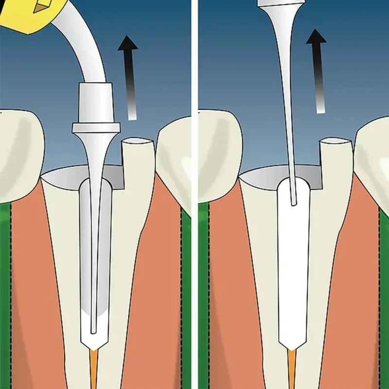 Prime Dental Rc Cal-I | Dental Product At Lowest Price