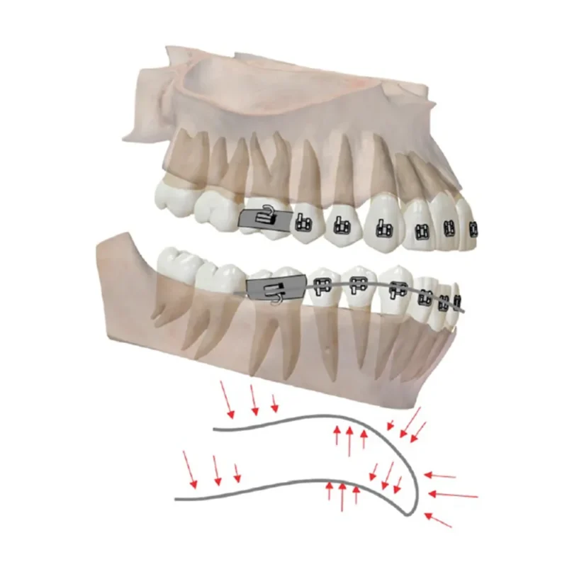 Phyx Reverse Curve NiTi Archwire Rectangle | Dental Product at Lowest Price