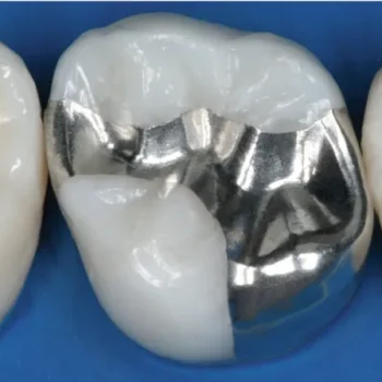 Waldent WalCap Amalgam Capsules - Image 2
