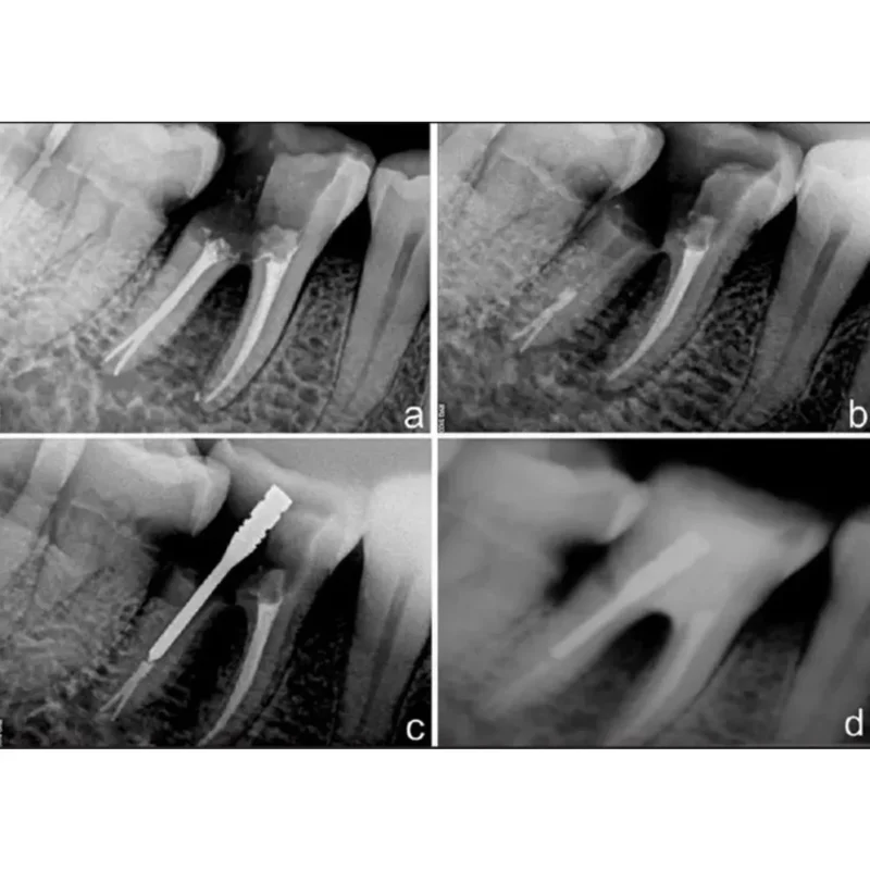 Prime Dental i Post Endodontic Metal Post Refills - Image 4