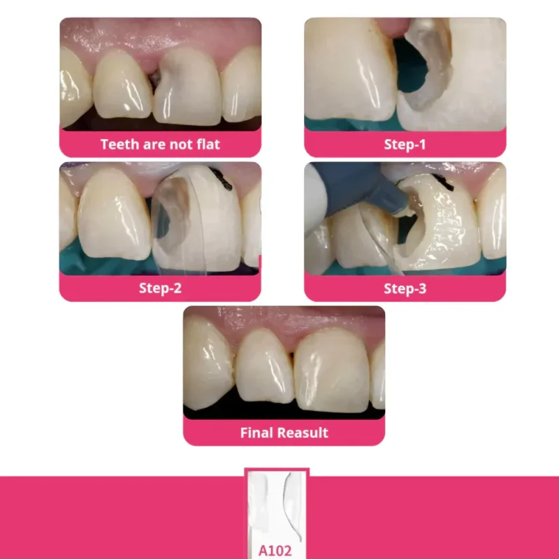 Bioclear Anterior Matrix Closure Series - Image 2