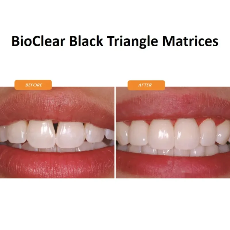 Bioclear Black Triangle (BT) Matrix System Kit - Image 9