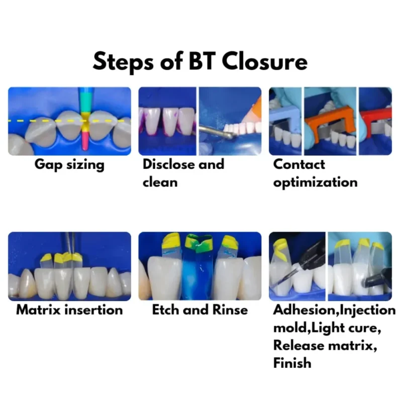 Bioclear Black Triangle (BT) Matrix System Kit - Image 7