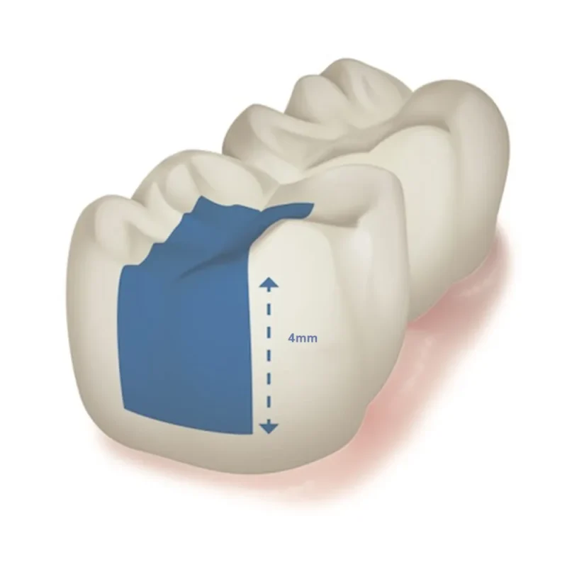 Prime Dental Restorite Bulk Fill (Flowable) - Image 2