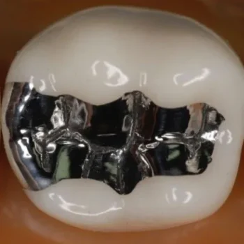 Waldent WalCap Amalgam Capsules - Image 11