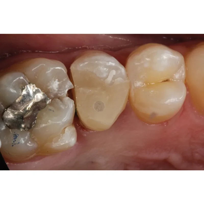 Prime Dental Restorite Core Build-Up - Image 3