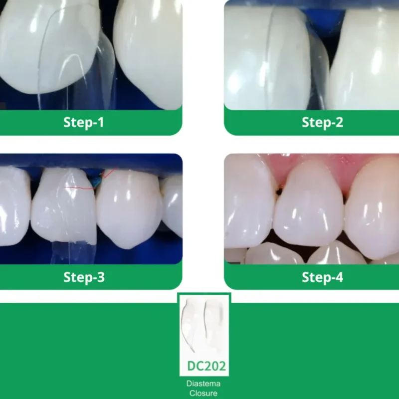 Bioclear Diastema Matrix Closure Series - Image 5