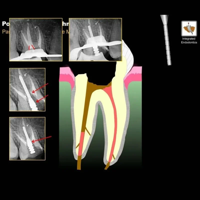 Prime Dental i Post Endodontic Metal Post Refills - Image 3