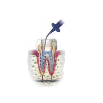 Cerkamed Endo Aspirator - Image 5