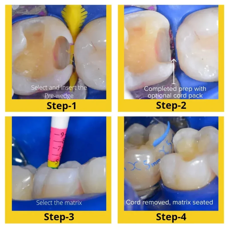 Bioclear Evolve Posterior Matrix Series - Image 4