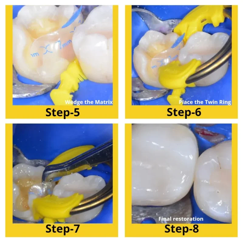 Bioclear Evolve Posterior Matrix Series - Image 3