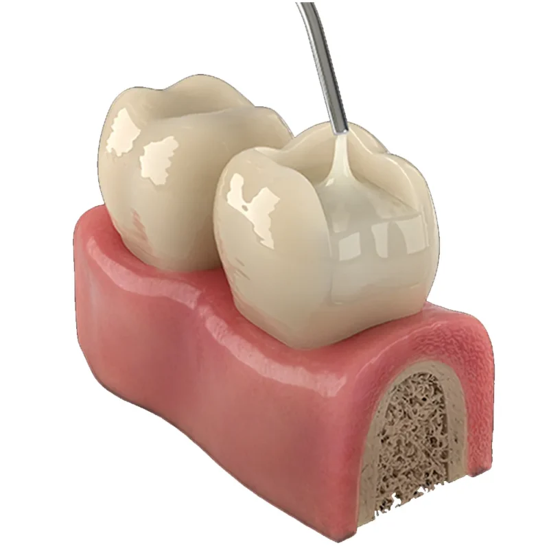 Prime Dental Restorite Bulk Fill (Flowable) - Image 4