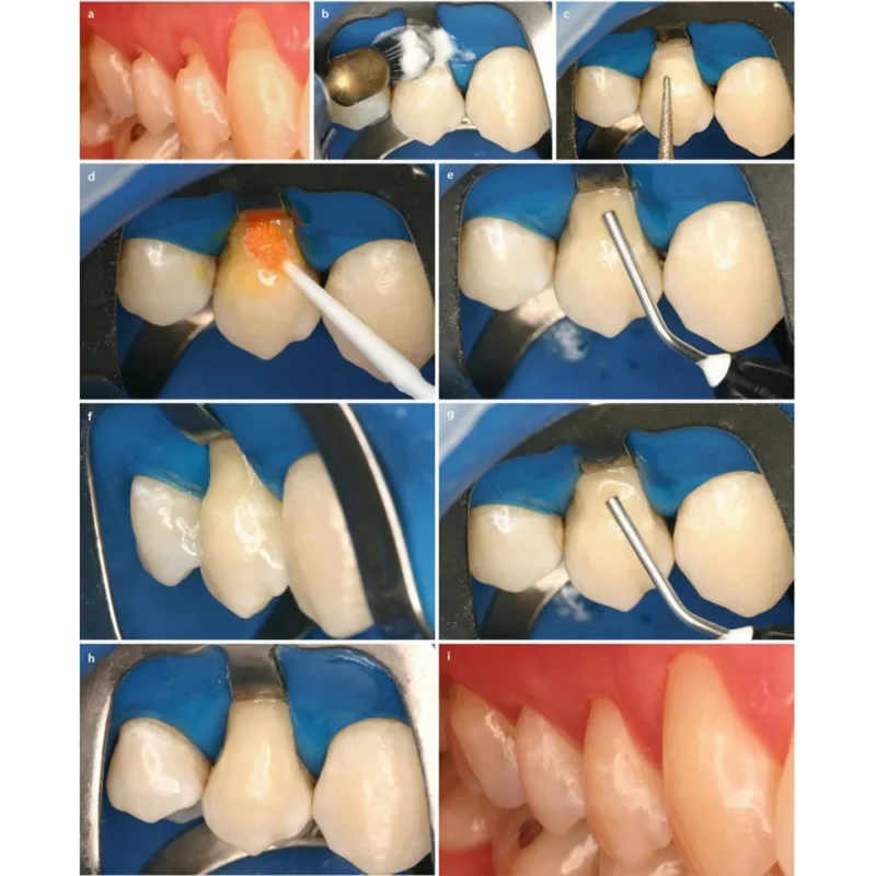 Prime Dental Restorite Flow Viscous Kit - Image 3