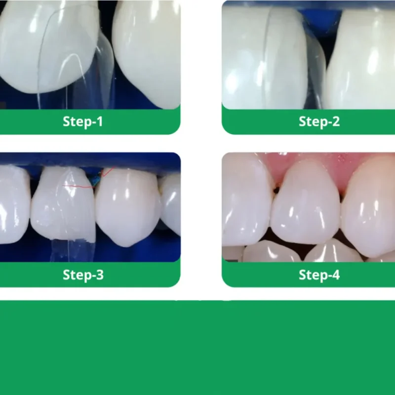 Bioclear Diastema HD Matrix Closure Series - Image 2