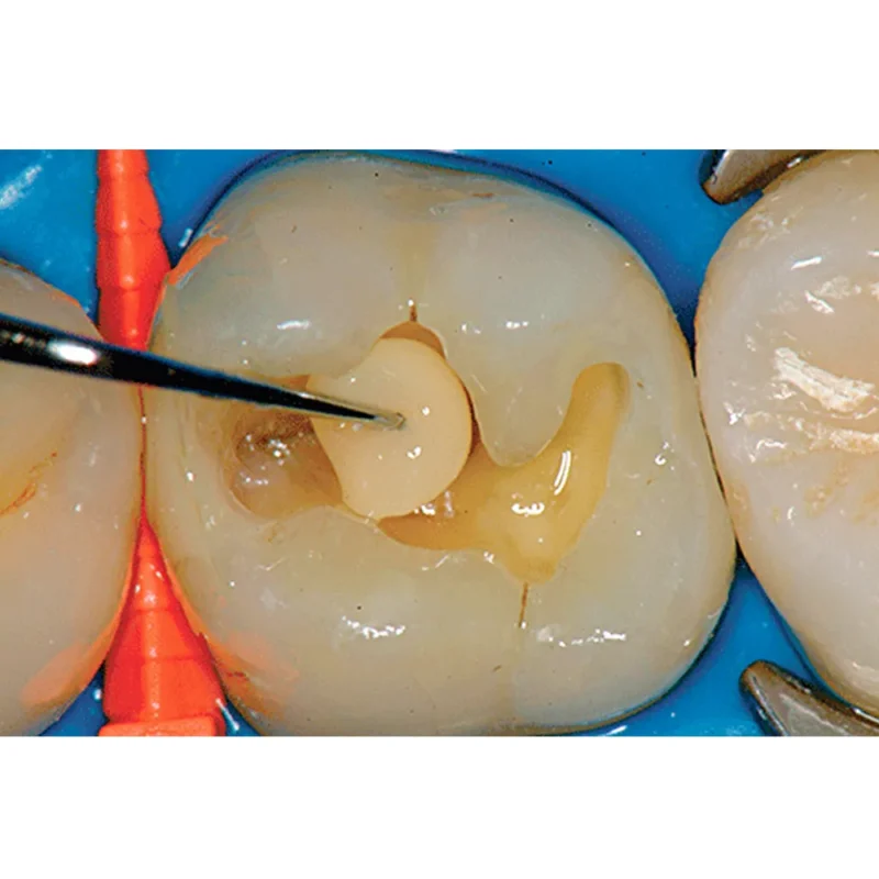 Prime Dental Restorite Micro Hybrid Composite - Image 3