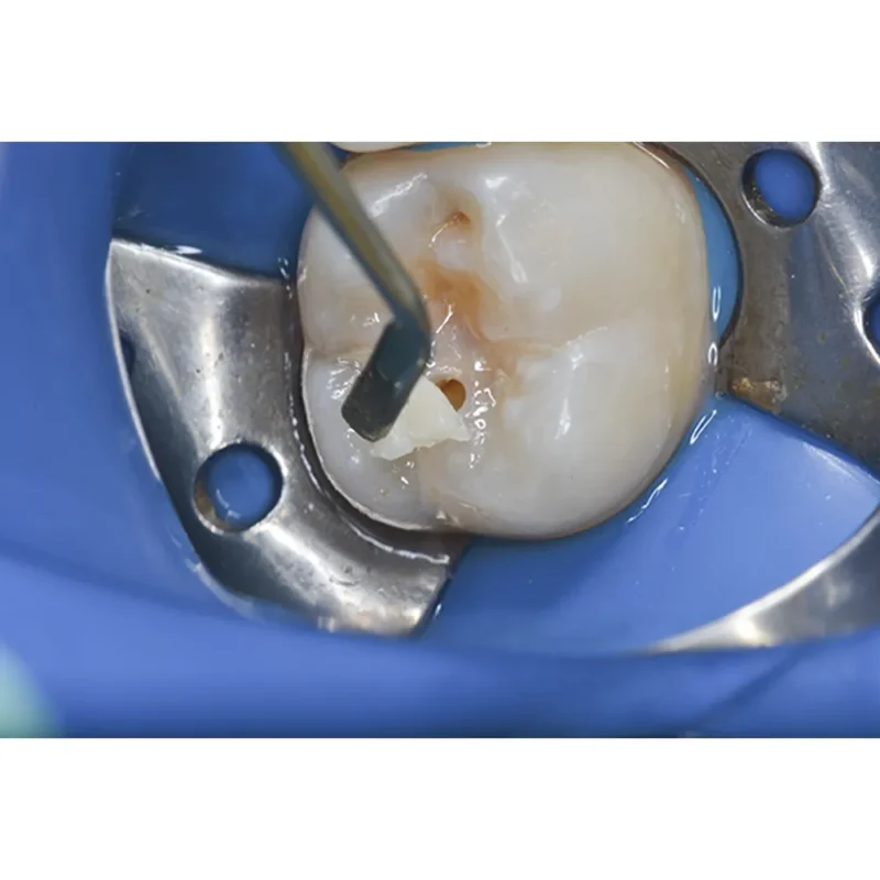 Prime Dental Restorite Micro Hybrid Composite - Image 2