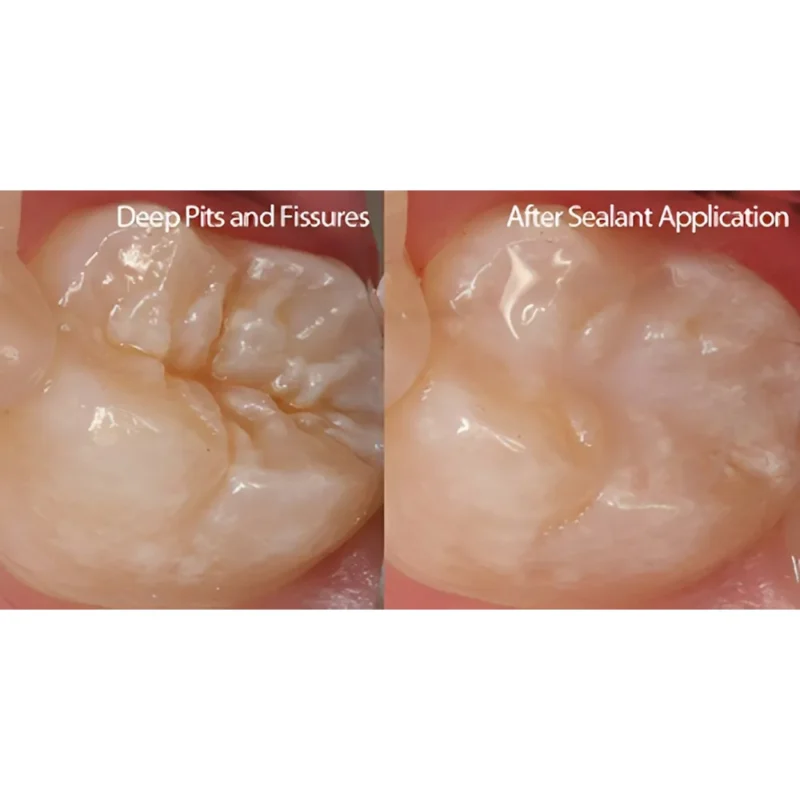 Prime Dental Restorite Pit & Fissure Sealant - Image 6