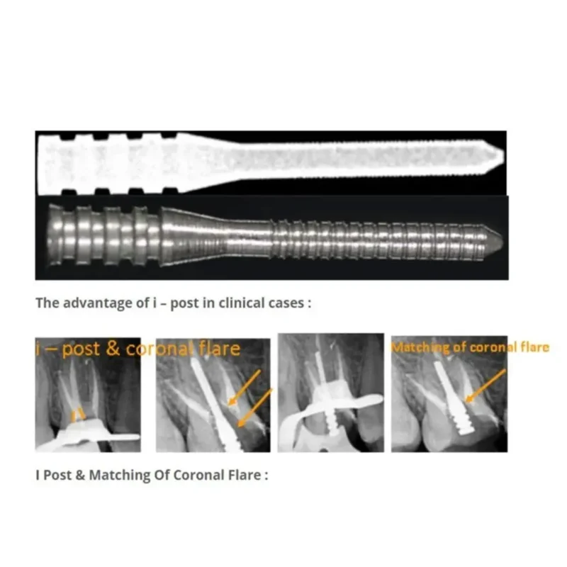 Prime Dental i Post Endodontic Metal Post Refills