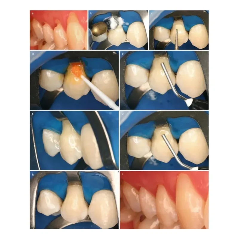 Prime Dental Restorite Flow Viscous Composite - Image 4