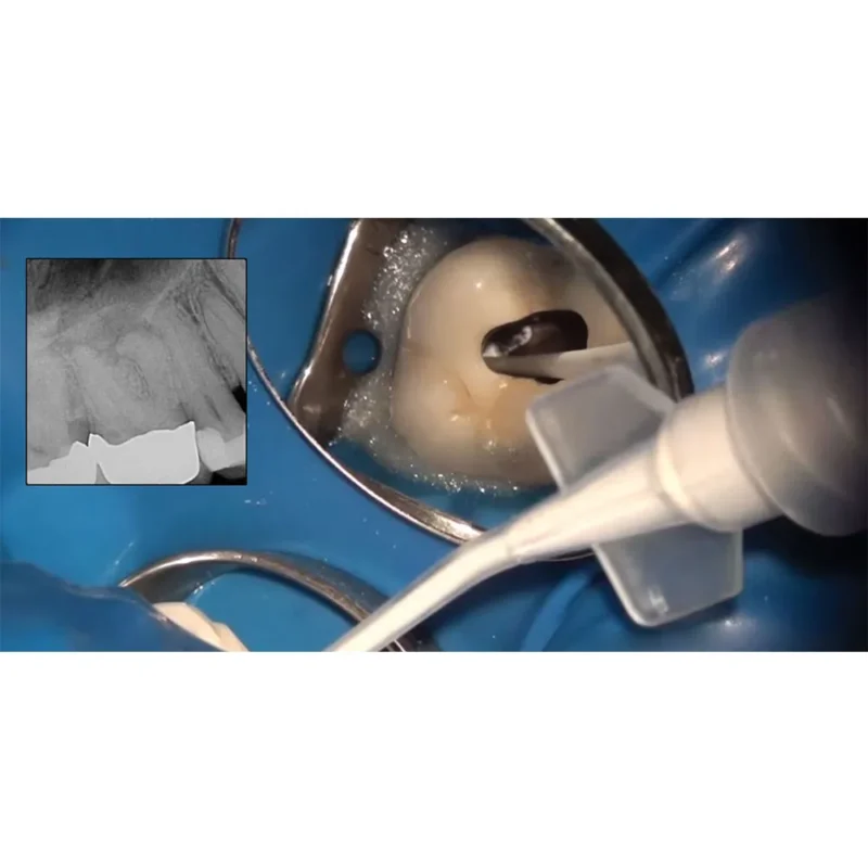 Prime Dental Prime MTA Bioceramic Root Canal Sealer - Image 3